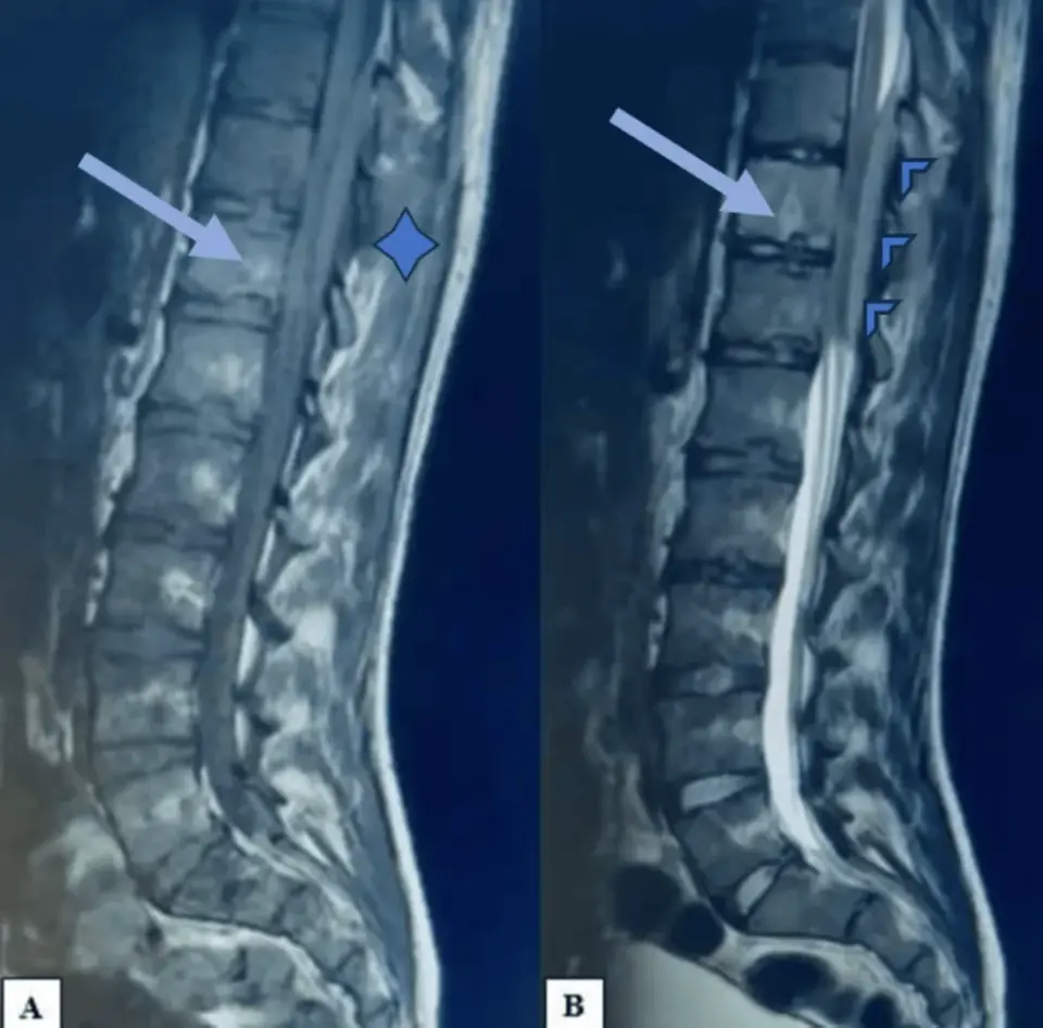 Rare Thoracic Ewing Sarcoma Diagnosed via Spinal Compression in 20-Year-Old