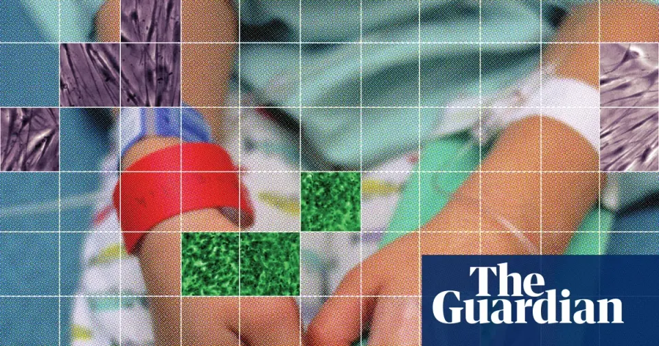 Unproven stem cell infusions for autism draw FDA warnings and political support