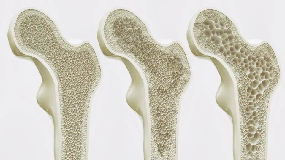 Large review finds calcium and vitamin D offer little protection against fractures