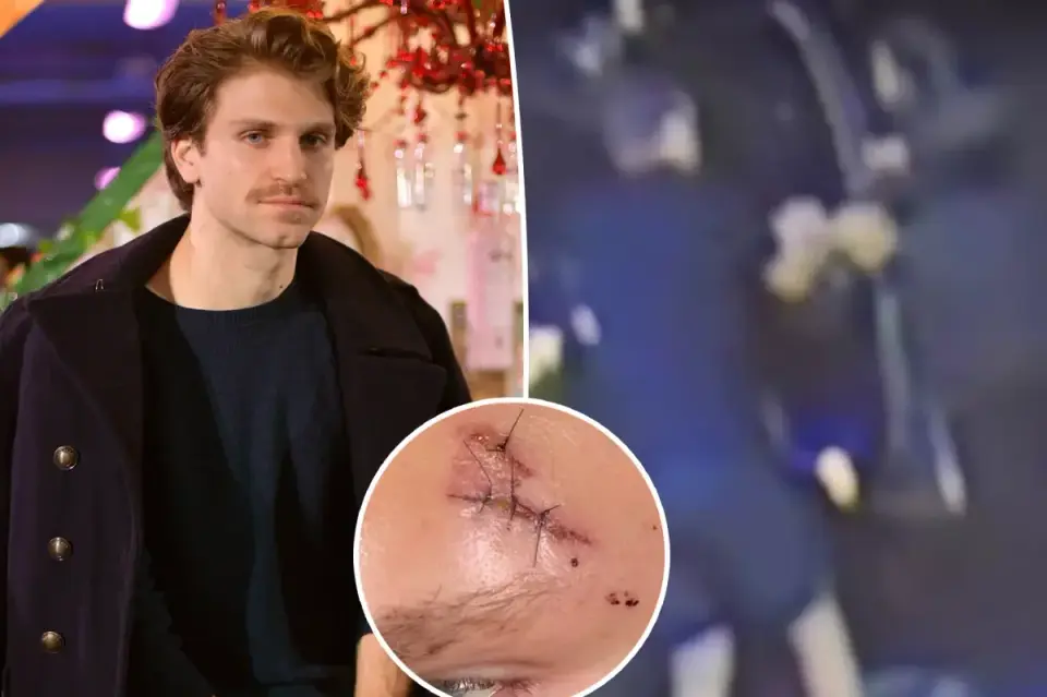 Keegan Allen reveals stitches after armed robbery in West Hollywood