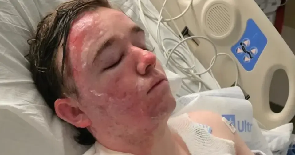 Yuba City McDonald’s worker severely burned after coworker hurls hot oil