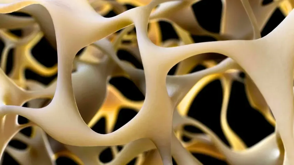Personal Stem Cells Show Promise in Reversing Osteoporosis in a Small Trial