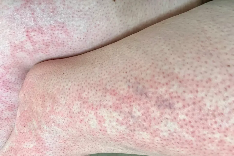 Laptop Heat Linked to 'Toasted Skin Syndrome' in Children