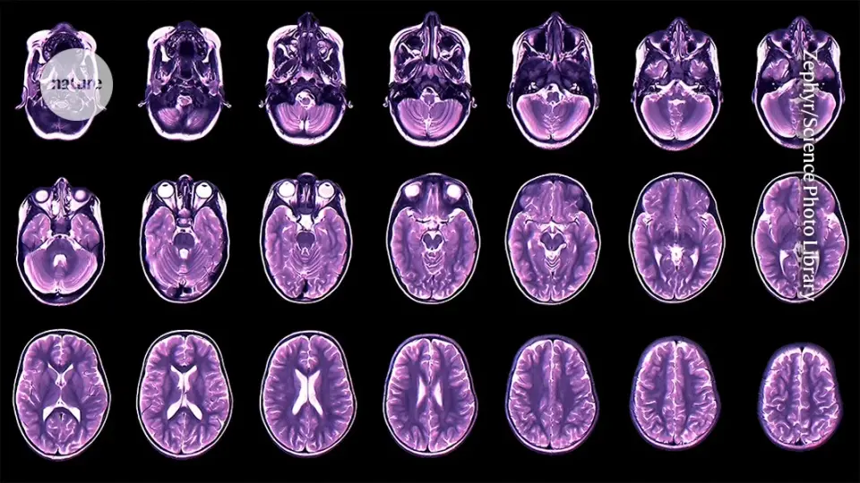Cortical Thinning Timelines Predict Adolescent Mental Health Risks