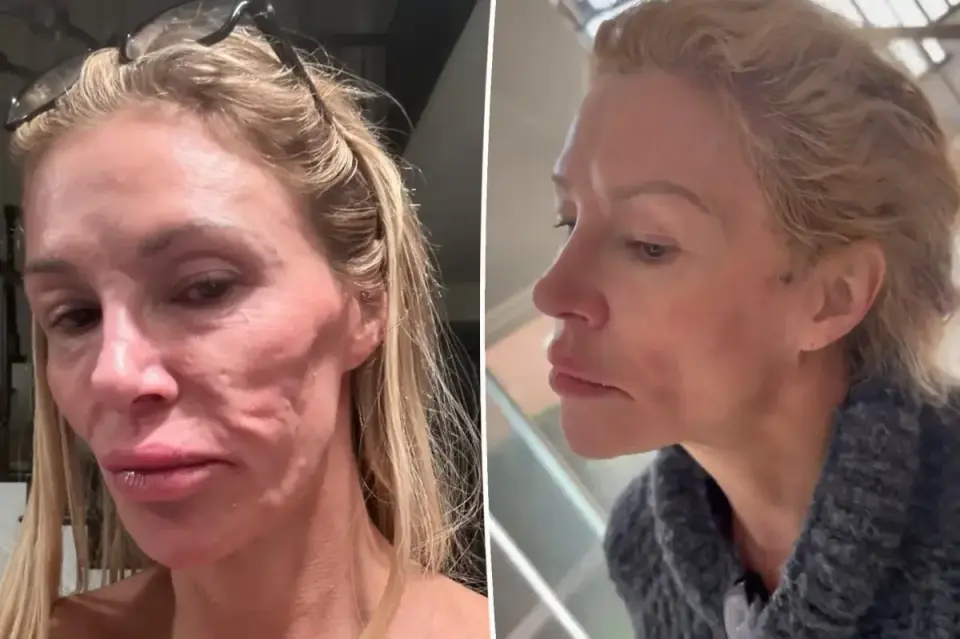 Brandi Glanville Undergoes Drastic Facial Surgery to Remove Mysterious Mass