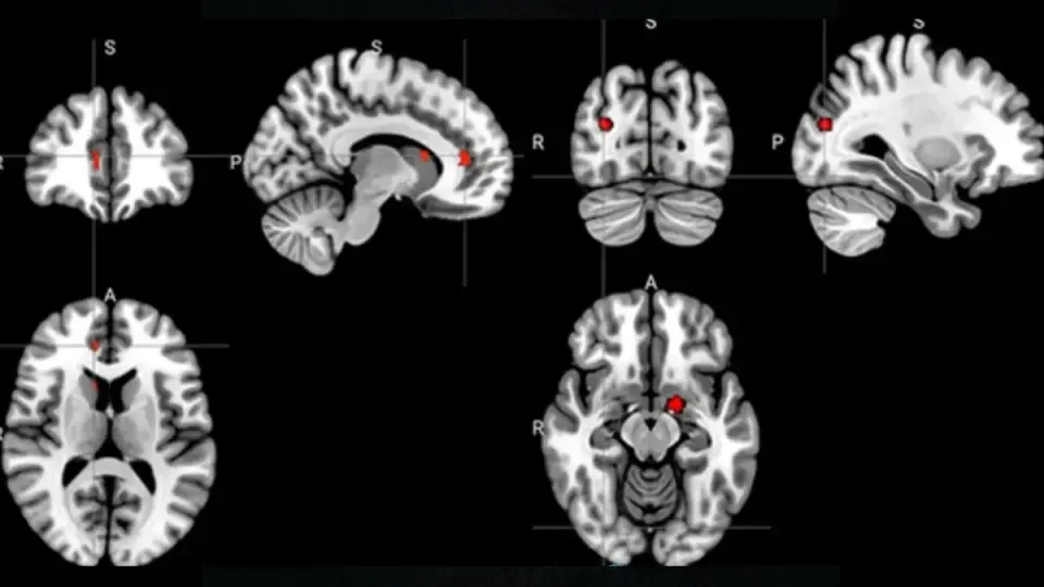 Acupuncture May Rewire Depression Brain Circuits, New Imaging Sheds Light