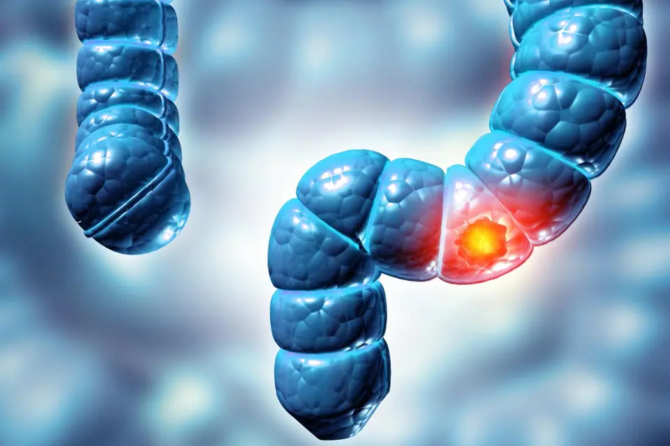 Colorectal Cancer Surges in Adults Under 50, Swiss Data Show