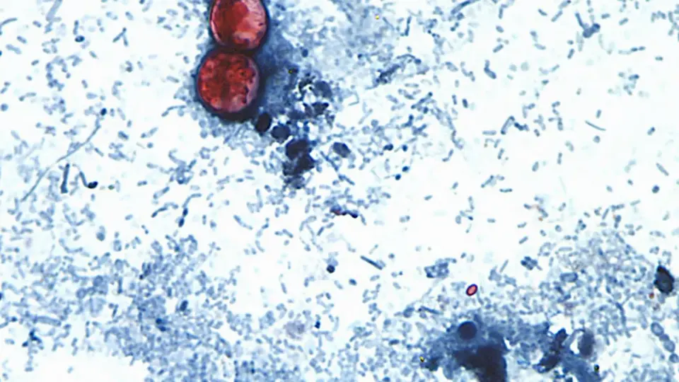 Cyclospora outbreak linked to Taylor Farms lettuce reaches 20 states, 11,458 cases