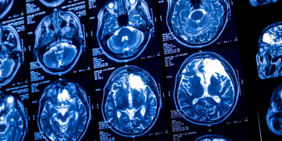 Lifelong light drinking and aging jointly linked to lower brain blood flow and thinner cortex