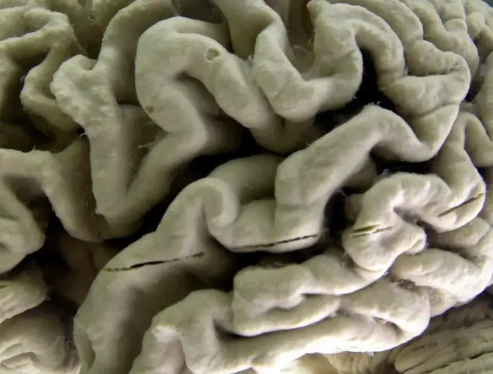 UCSD study maps a molecular switch to prevent Alzheimer’s in mice