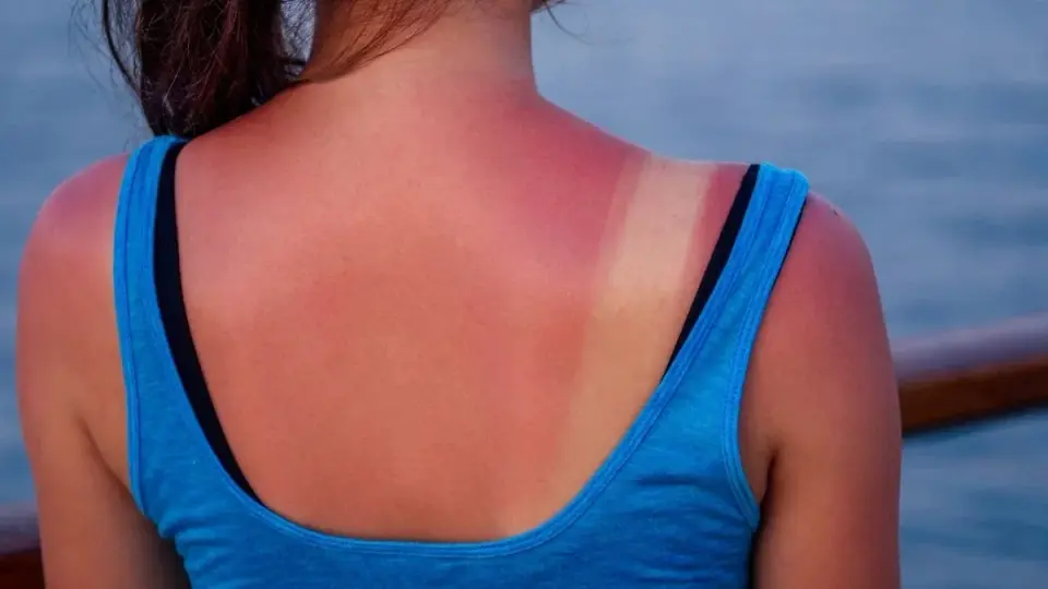 A Single Severe Sunburn in Youth Linked to Higher Skin Cancer Risk