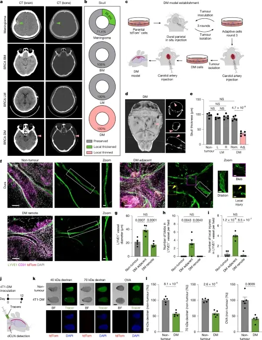 Cancer-Driven Osteoclasts Disrupt Meningeal Lymphatics to Suppress Immunity in Dural Metastasis