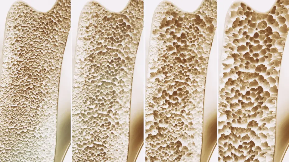 Large Review Finds Calcium and Vitamin D Supplements Do Not Significantly Prevent Falls or Fractures