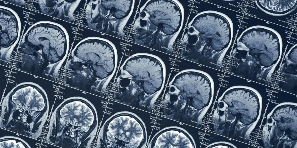 Shift Work Linked to Subtle Shrinkage in Amygdala and Thalamus, Reversible Upon Stopping