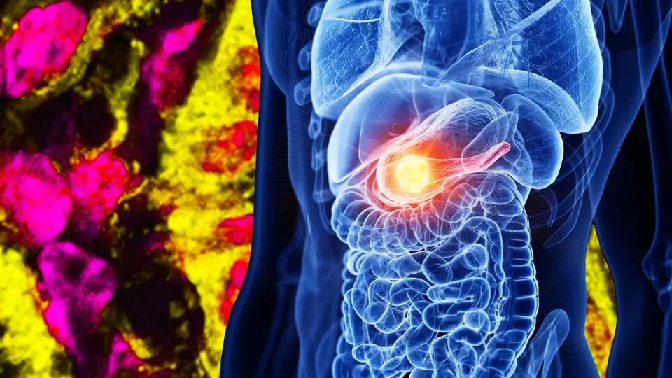 Breakthrough in Pancreatic Cancer Tests the Value of Federal Science Funding
