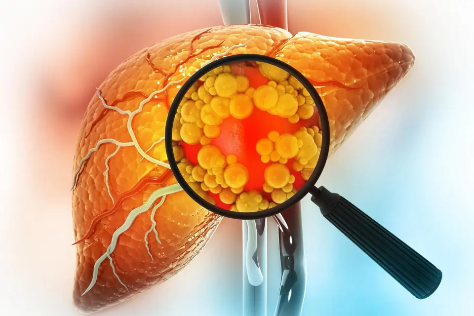 Eliminating senescent macrophages reverses fatty liver in mice
