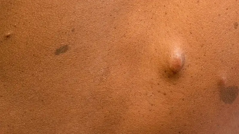 NF1-Associated Cherry Angiomas Map a Vascular Tumor Mechanism