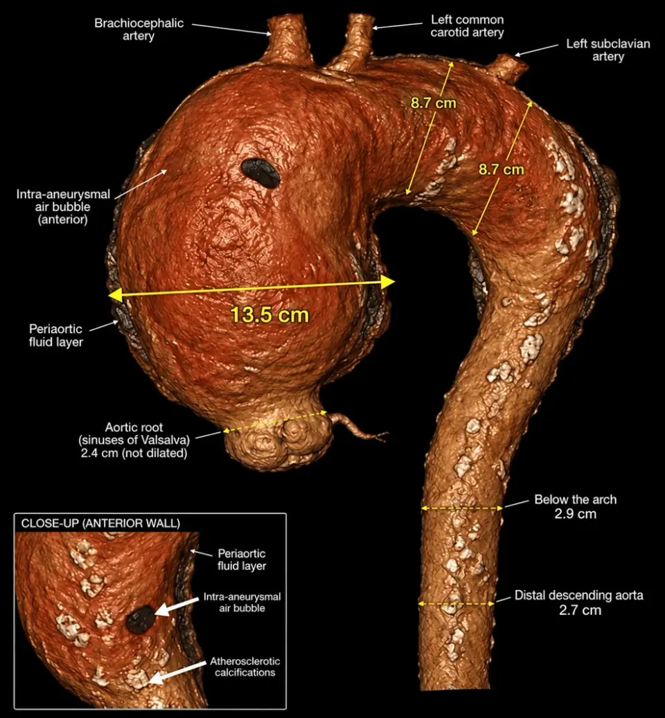 Surgeons Repair 13.5 cm Atherosclerotic Aortic Aneurysm in 70-Year-Old Woman