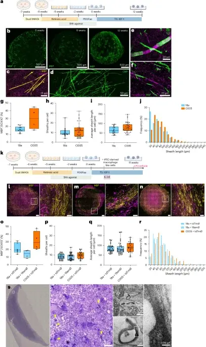 Human Stem Cell Model Mimics Multiple Sclerosis Myelin Damage and Repair
