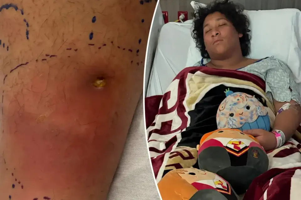 Florida teen fights for life after flesh-eating bacteria from park swim