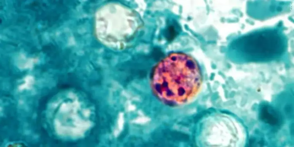 Maine reports 10 cyclosporiasis cases in multistate iceberg lettuce outbreak