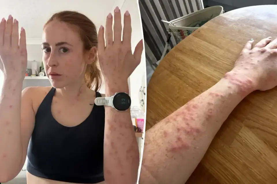 Cambridge Travelodge Bedbug Fallout Prompts Apology and Compensation
