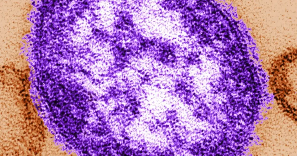 Santa Barbara County Sees First Measles Case Since 2019