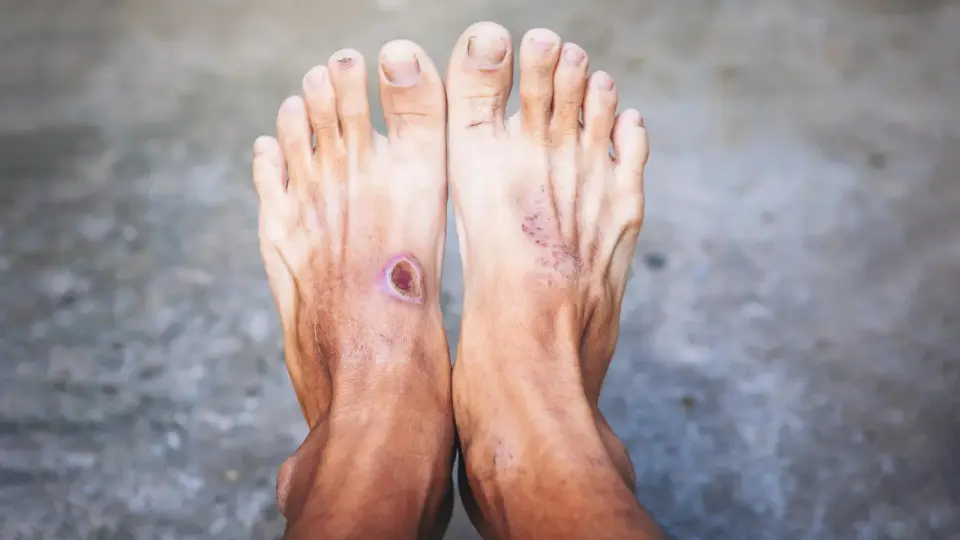 Immune Dysregulation Identified as Key Driver in Chronic Diabetic Ulcers