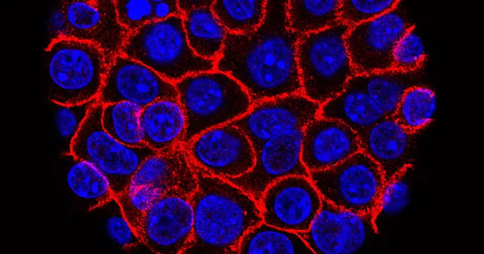 Georgia hospitals launch trials of a promising pancreatic cancer drug