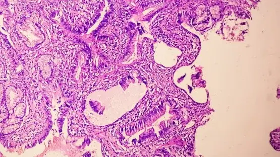 PSA Alone Can Miss Prostate Cancer Growth; Regular Imaging Urged