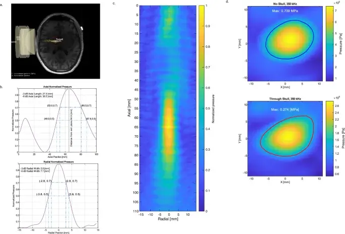 Pilot Trial Finds 10-Minute Ultrasound Sessions Reduce Delusions in Schizophrenia