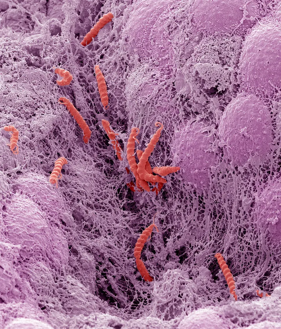 Infections Account for 12% of Global Cancers, Study Finds