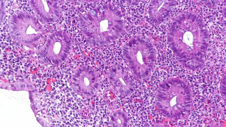 Abivax UC drug delivers strong remission in Phase 3, but safety signals spark caution