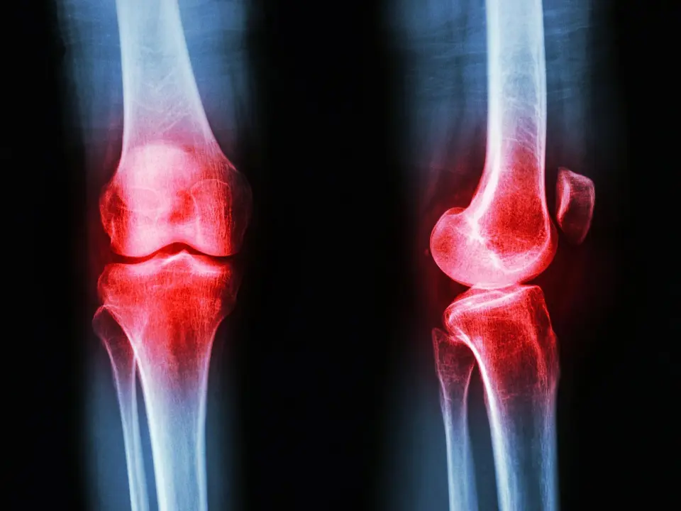 SHP Protein Emerges as Potential Breakthrough to Stall Osteoarthritis