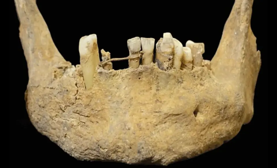 500-Year-Old Gold Ligature Reveals Elite Medieval Dentistry in Scotland