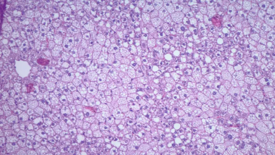 Food-Systems Lens Links Western Diet and Binge Drinking to Rapid Fatty Liver Progression