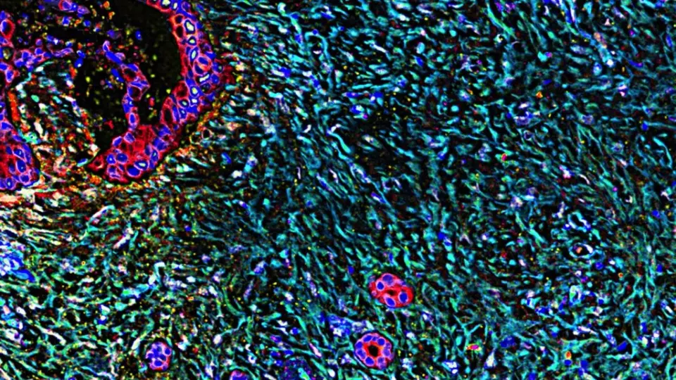 Daraxonrasib Poised to Redefine Second-Line Pancreatic Cancer Care