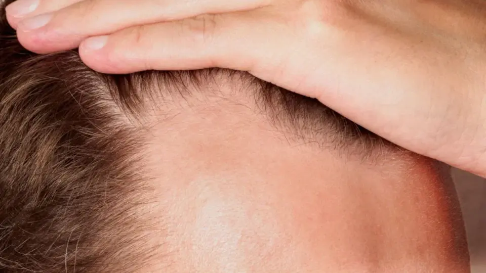 Oral Minoxidil Clears Hair-Loss Trial Hurdle, Eyes Regulatory Approval