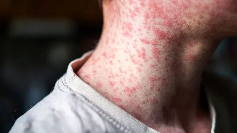 Adult Measles Surge Tests Vaccination Gaps and Clinical Vigilance