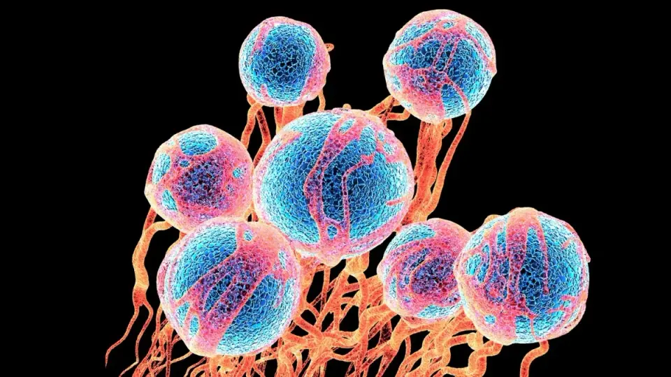 Sugary Signal: Fructose From Senescent Cancer Cells May Drive Ovarian Tumor Spread