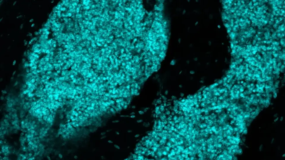 Hidden Skull Immune Hubs May Help Fight Brain Cancer