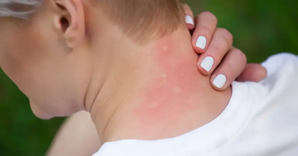 Why Mosquitoes Bite Some People More—and How to Prevent It