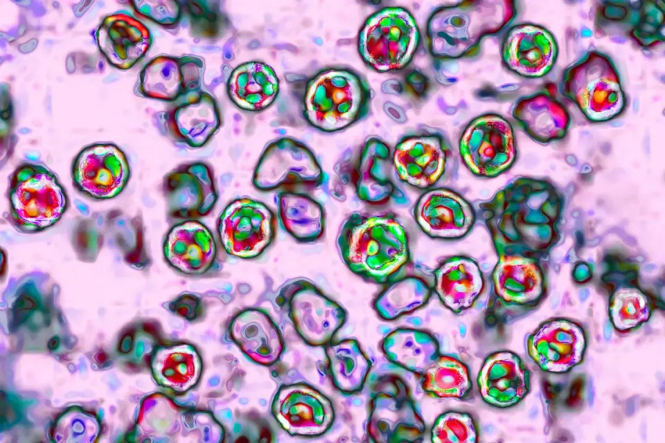 PA records first measles deaths in 35 years as outbreak fuels vaccine debate