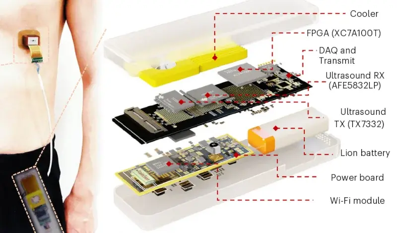 The Pacemaker Patch: An External Ultrasound Approach to Pacing the Heart