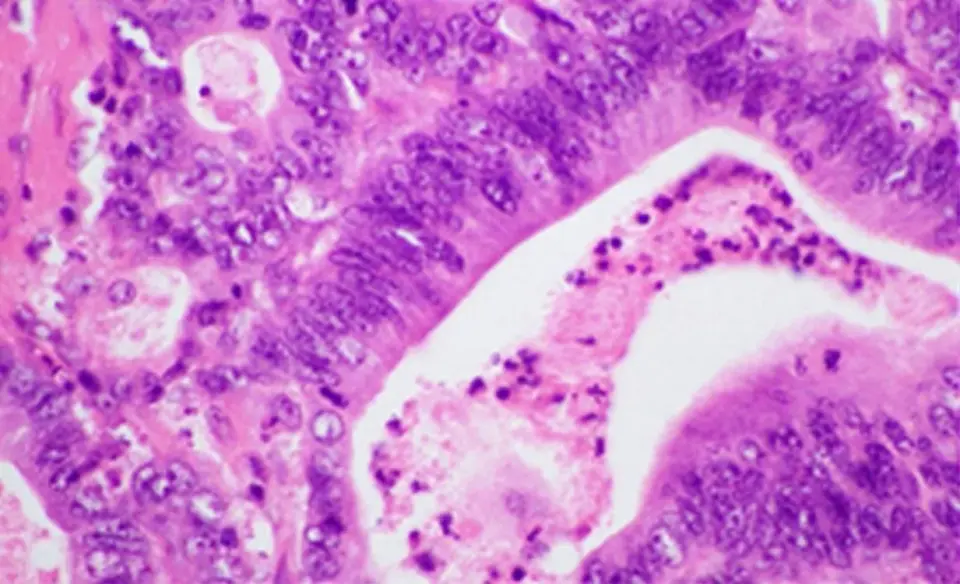KRAS-Targeted Drug Sparks Immune Defense to Prevent Pancreatic Cancer in High-Risk People