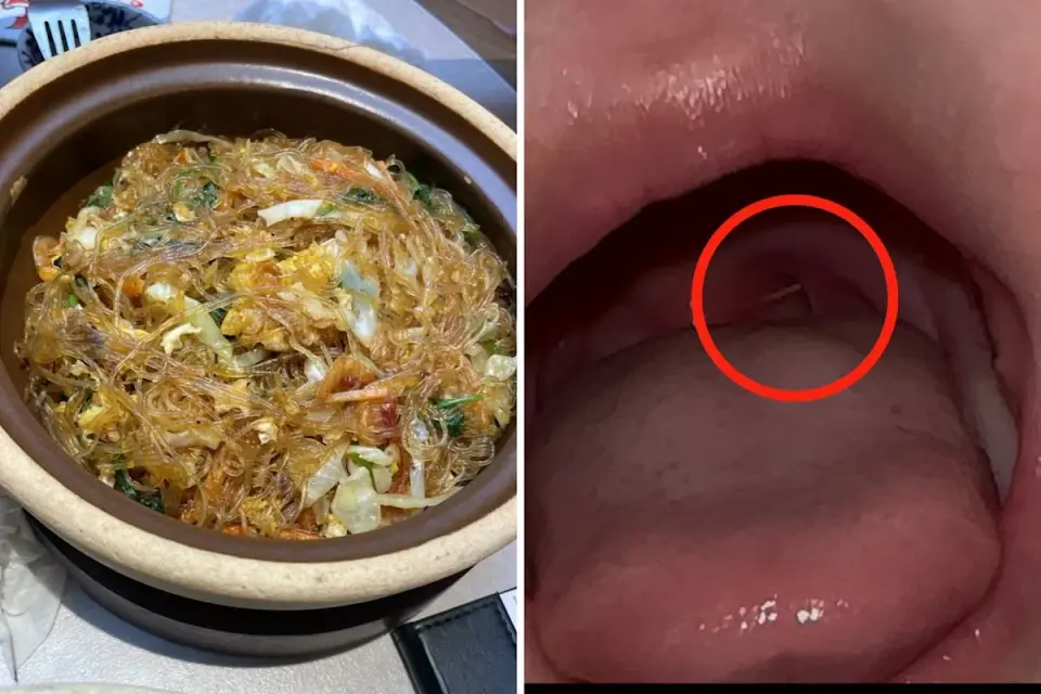 Lunch Out, Big Scare: Toddler’s shrimp bone prompts hospital visit