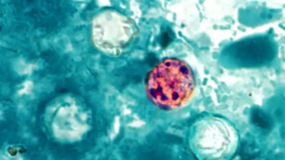 Michigan reports first Cyclospora-linked deaths amid multistate outbreak