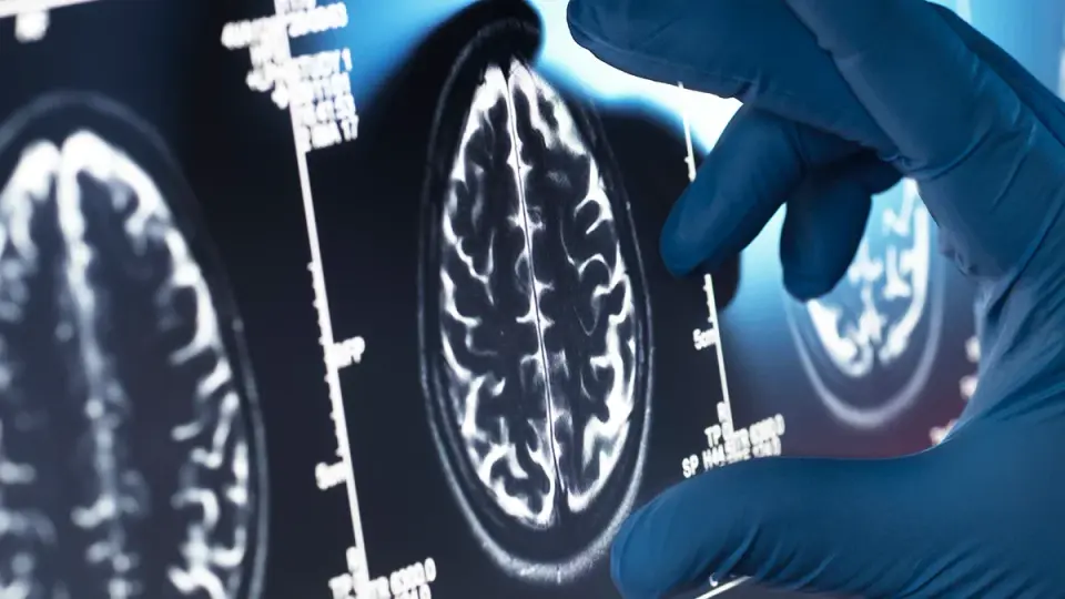 Shared brain network disruptions link schizophrenia and bipolar disorder, study finds