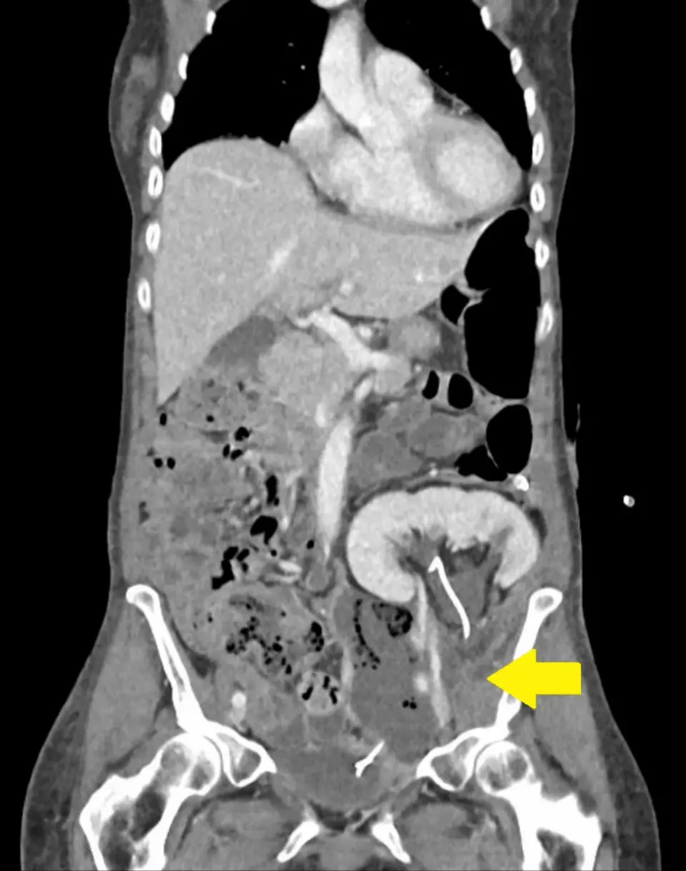 Hyponatremia Reveals Hidden Peritransplant Abscess After Kidney Transplant