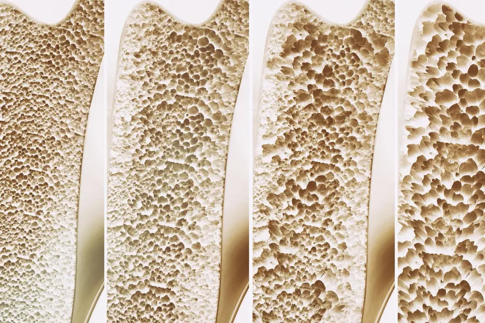 Vitamin K Orchestrates Bone Remodeling via GAS6 Signaling